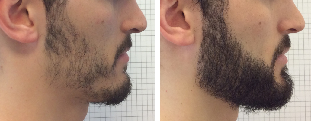 Пересадка волос на бороду: как сделать бороду гуще?