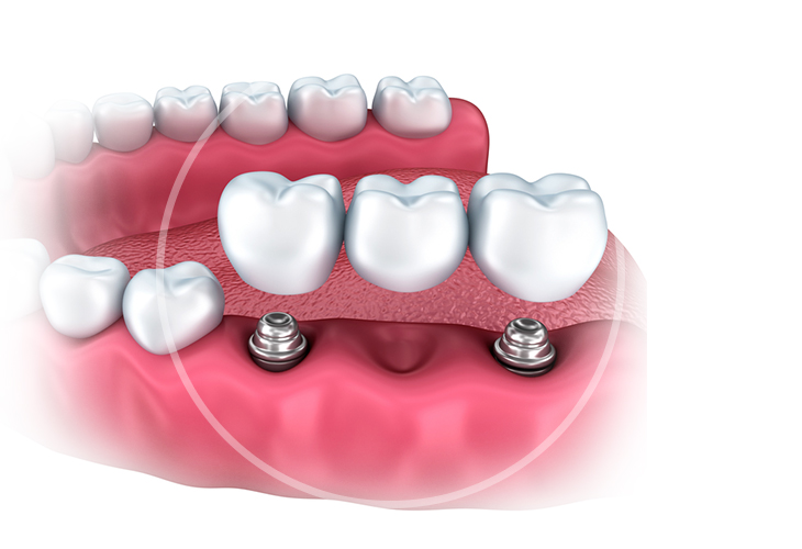 Какие импланты лучше ставить на жевательные зубы?