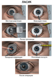 Лазерная коррекция зрения: как проходит операция?