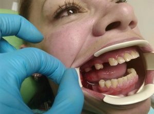 Как происходит протезирование зубов?