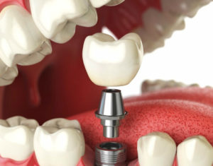 Что представляет собой имплантация зубов?