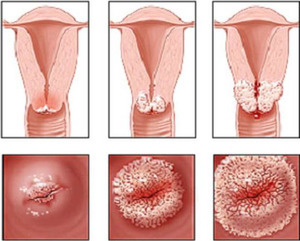 Эндоцервицит шейки матки: признаки и лечение