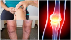 Остеоартроз коленного сустава: диагностика и лечение