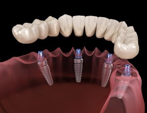 Имплантация зубов в стоматологии