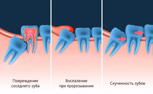 Зуб мудрости: лечить или удалять?