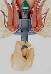 Виды хирургических операций при геморрое