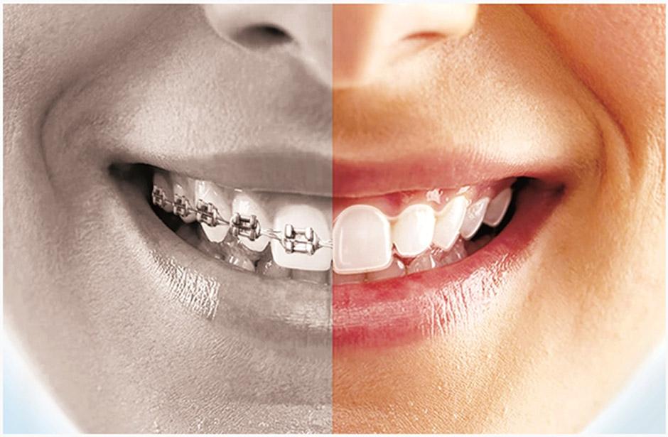 Сравнение брекетов и элайнеров: что лучше для выравнивания зубов?