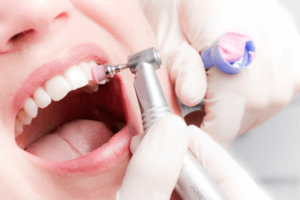 Профессиональная чистка зубов в стоматологии: эффективная гигиеническая процедура