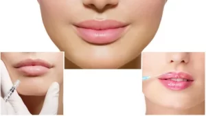 Увеличение губ гиалуроновой кислотой: преимущества и причины популярности процедуры