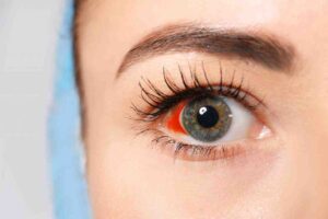 Что делать, если белок глаз налился кровью?