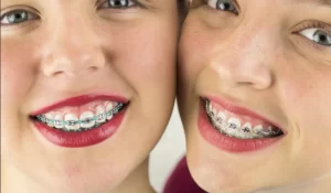 Виды брекетов на зубы: какой выбрать