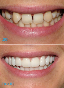 Виниры: плюсы и минусы