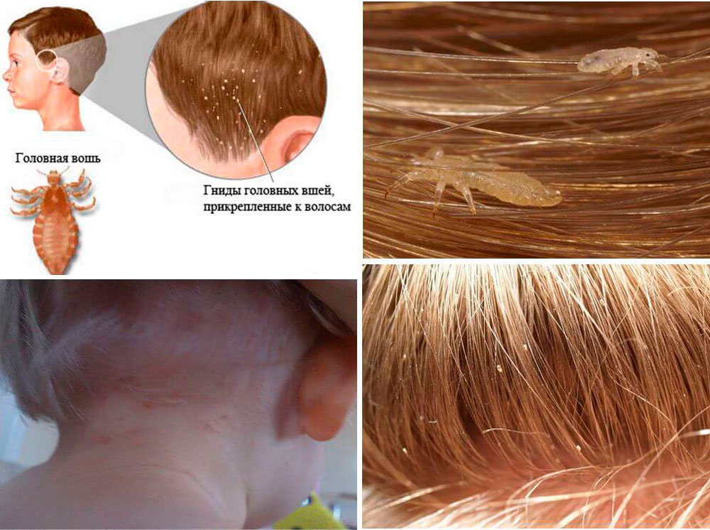 Чем опасны вши, почему нельзя игнорировать лечение