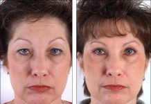 Блефаропластика: контурная пластика век, позволяющая решить ряд возрастных и косметических проблем