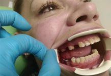 Как происходит протезирование зубов?