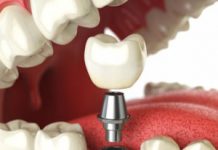 Что представляет собой имплантация зубов?