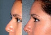 Как делается безоперационная ринопластика?
