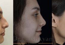 Ринопластика: все, что нужно знать пациенту об этой популярной процедуре