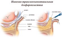 Особенности трансконъюнктивальной блефаропластики