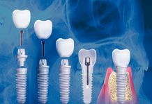 Виды имплантации зубов