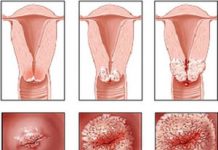 Эндоцервицит шейки матки: признаки и лечение