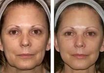 Виды лазерного омоложения лица