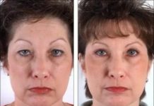 Блефаропластика: контурная пластика век, позволяющая решить ряд возрастных и косметических проблем