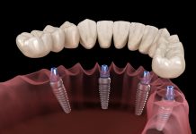 Имплантация зубов в стоматологии