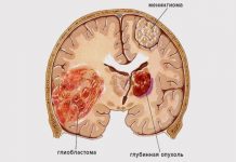 Глиобластома головного мозга