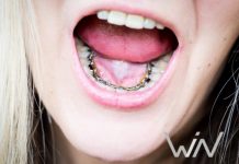 Лингвальные брекеты WIN