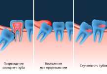 Зуб мудрости: лечить или удалять?