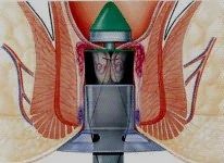 Виды хирургических операций при геморрое