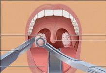 Причины воспаления аденоидов у детей