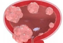 Почему возникает рак мочевого пузыря?
