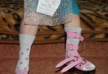 Брейсы Понсети для эффективного лечения косолапости у детей