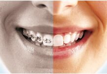 Сравнение брекетов и элайнеров: что лучше для выравнивания зубов?
