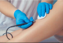 Электроэпиляция: позволяет навсегда удалить нежелательные волосы практически в любой области тела