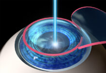 Методы лазерной коррекции зрения