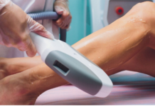 Лазерная эпиляция: качественный метод удаления волос