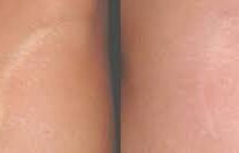 Камуфляж рубцов татуажем