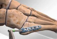 Остеосинтез костей: плюсы и минусы