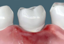 Лечение пародонтита