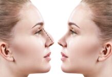 Искусство преображение: все, что нужно знать о ринопластике