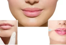 Увеличение губ гиалуроновой кислотой: преимущества и причины популярности процедуры