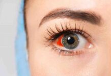 Что делать, если белок глаз налился кровью?