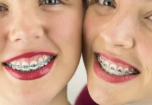 Виды брекетов на зубы: какой выбрать