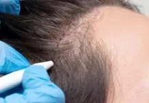 Пересадка волос методом Follicular Unit Extraction — эффективный путь к здоровью и привлекательности