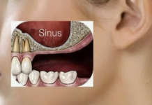 Синус-лифтинг: хирургическое решение проблемы недостатка костной ткани для успешной имплантации зубов