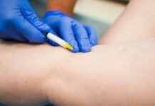 Что такое микросклеротерапия и как она проводится